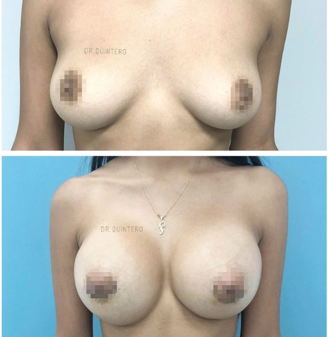 Aumento de pecho mamoplastia antes y despues