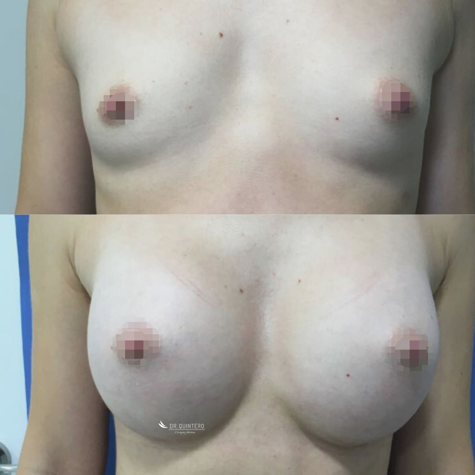Aumento de pecho mamoplastia antes y despues