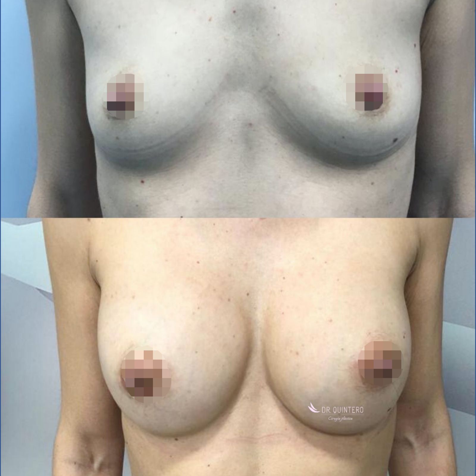 mamoplastia de aumento antes y después