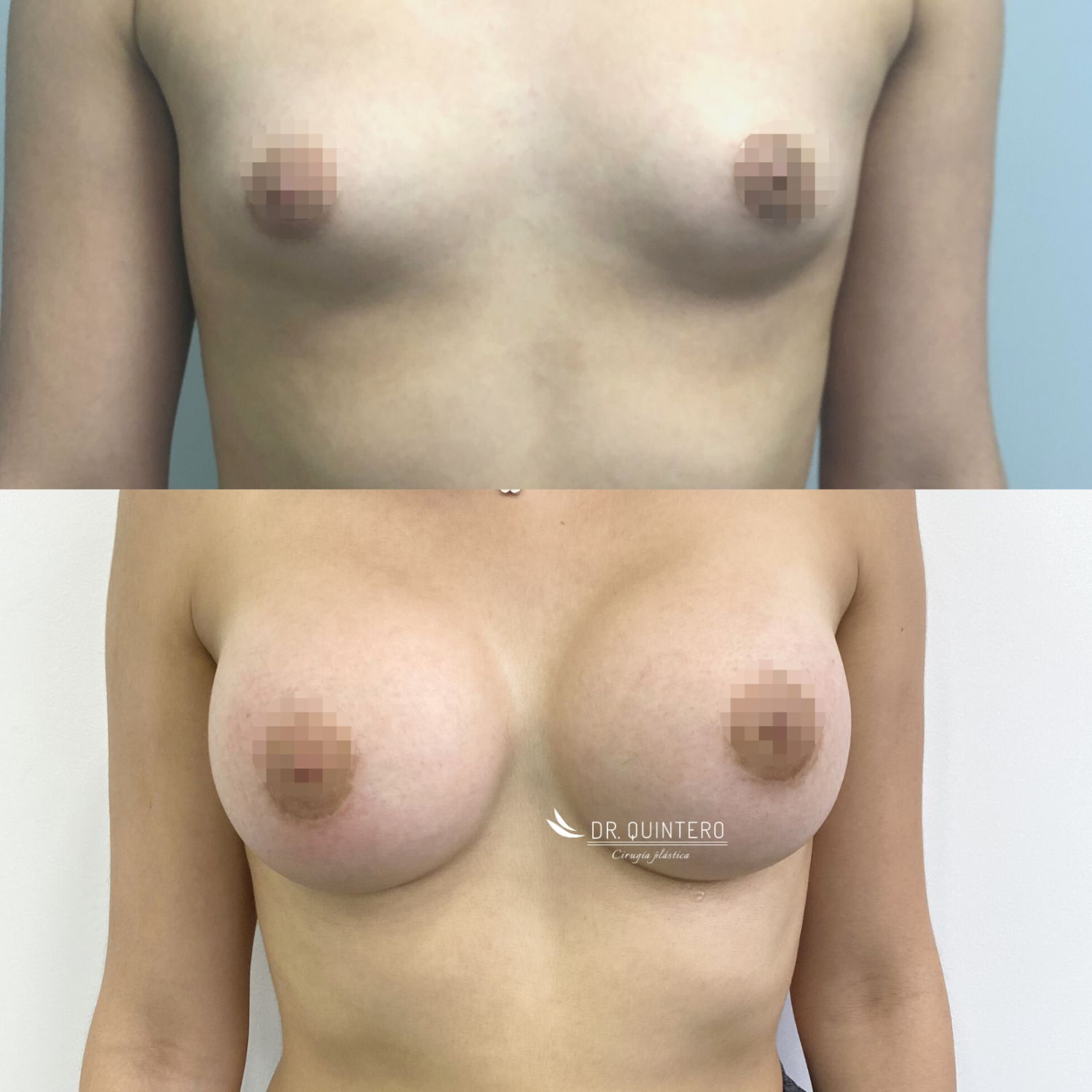 mamoplastia de aumento antes y después